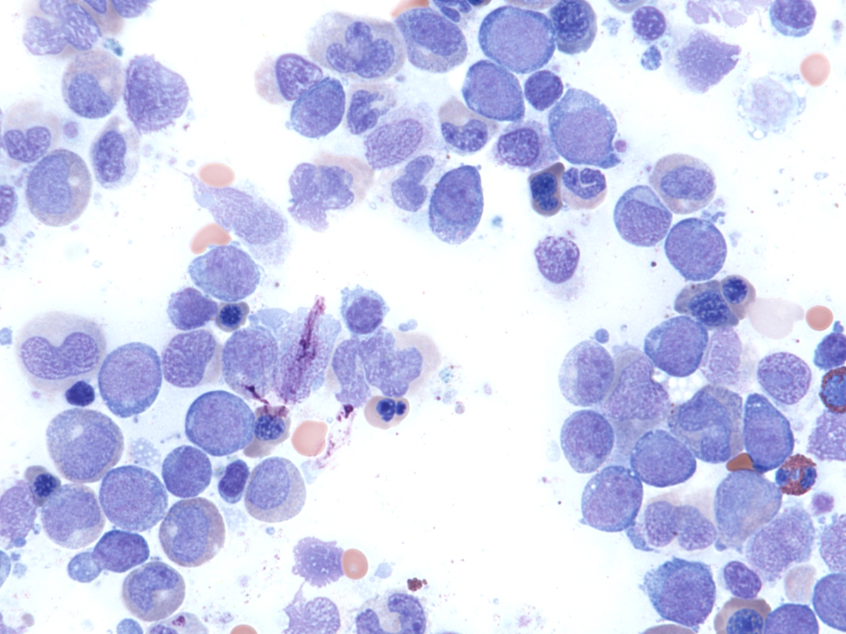 bone marrow aspirate with blasts and dysplastic myeloid and erythroid precursors